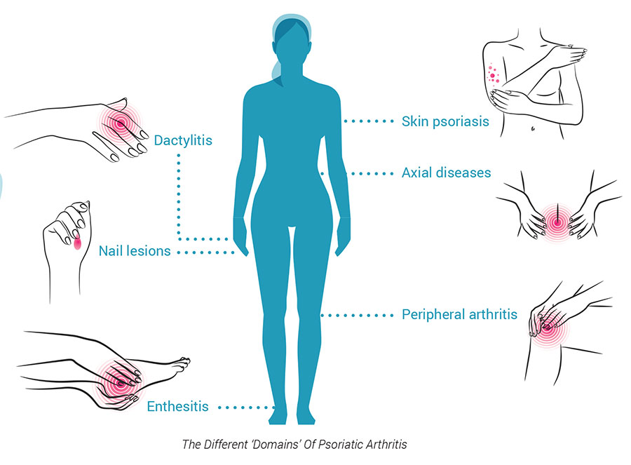 Domains of Psoriatic Arthritis