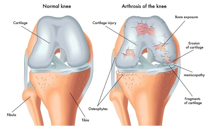  knee arthritis
